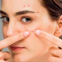 Kenapa Jerawat Sering Muncul di Tempat yang Sama? Ini Penjelasan Dokternya