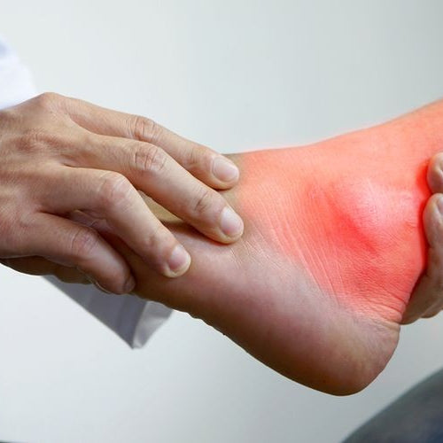 Nyeri Sendi Akibat Asam Urat: Apa Penyebab dan Bagaimana Mengatasinya?