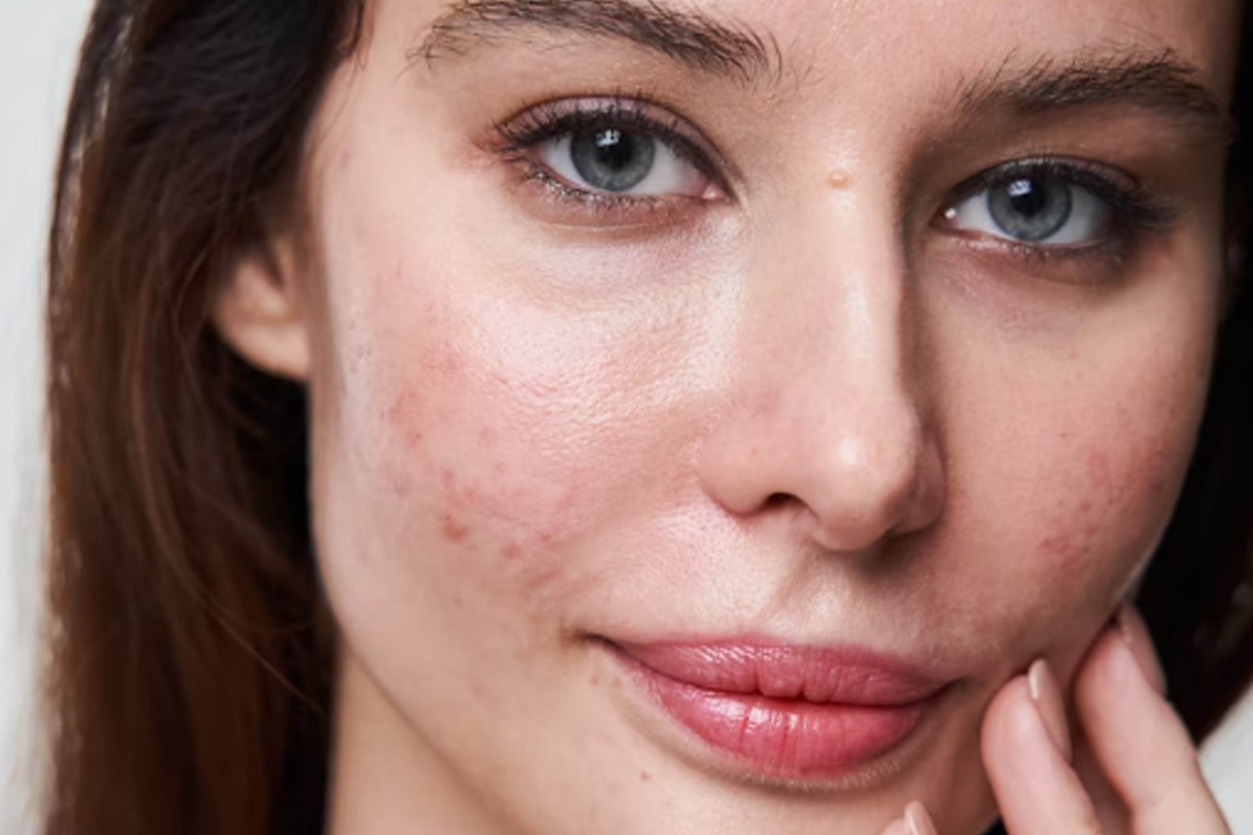 Dari Hormon hingga Gaya Hidup: Inilah Penyebab Jerawat yang Sering Terlupakan