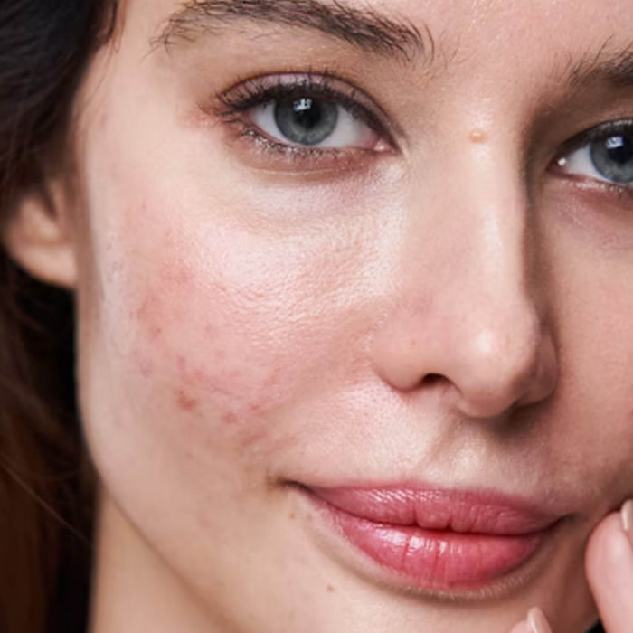 Dari Hormon hingga Gaya Hidup: Inilah Penyebab Jerawat yang Sering Terlupakan