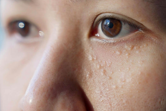 Milia pada Wajah: Apakah Berbahaya dan Kapan Harus ke Dokter?