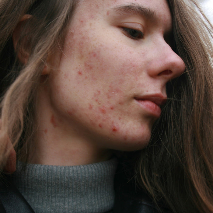 Purging vs Breakout: Kenali Perbedaannya Sebelum Panik!