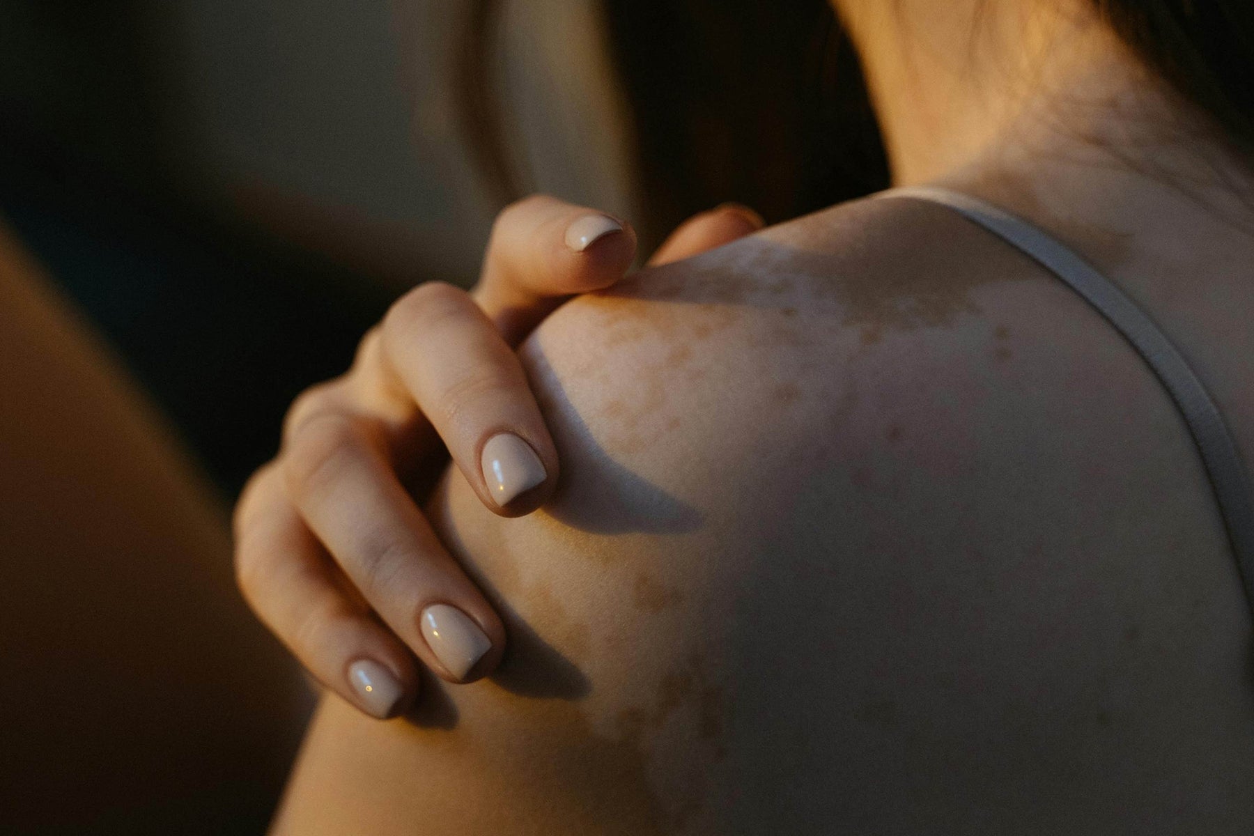 Mengenal Vitiligo: Penyakit Kulit yang Bukan Sekadar Perubahan Warna