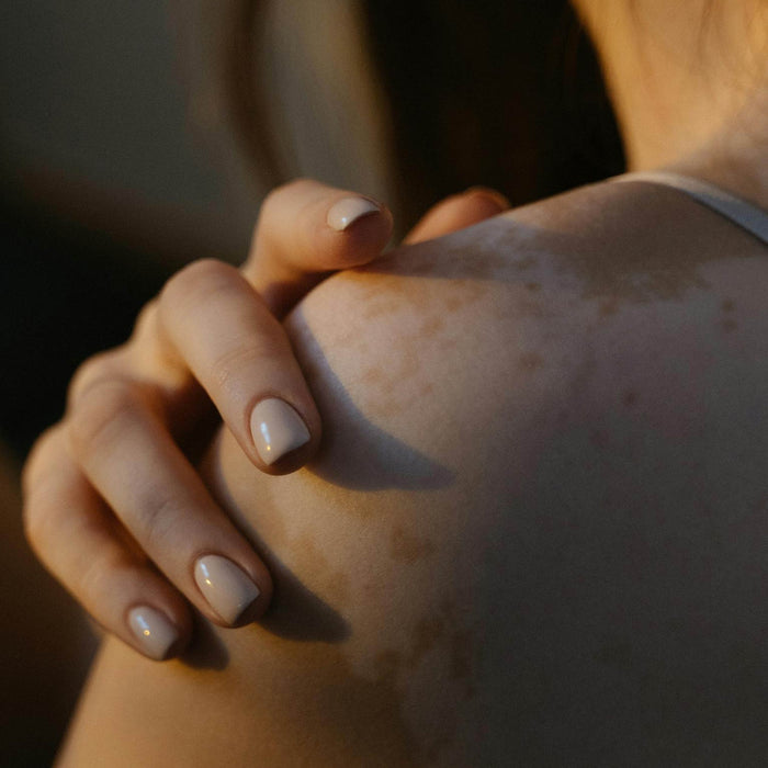 Mengenal Vitiligo: Penyakit Kulit yang Bukan Sekadar Perubahan Warna