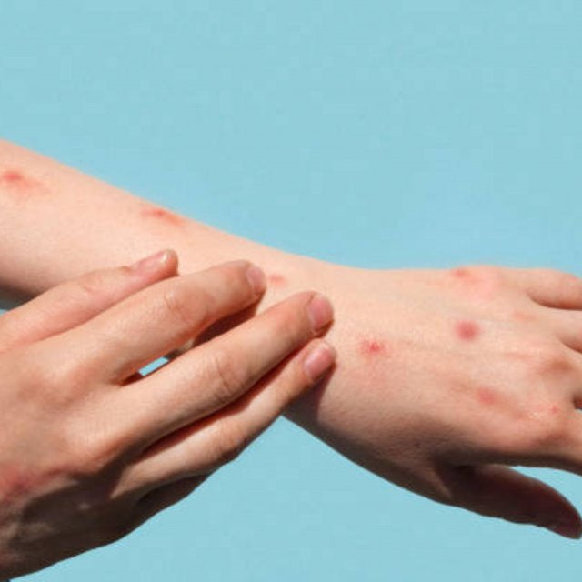 Bintik Merah di Kulit: Penyebab dan Cara Mengatasinya