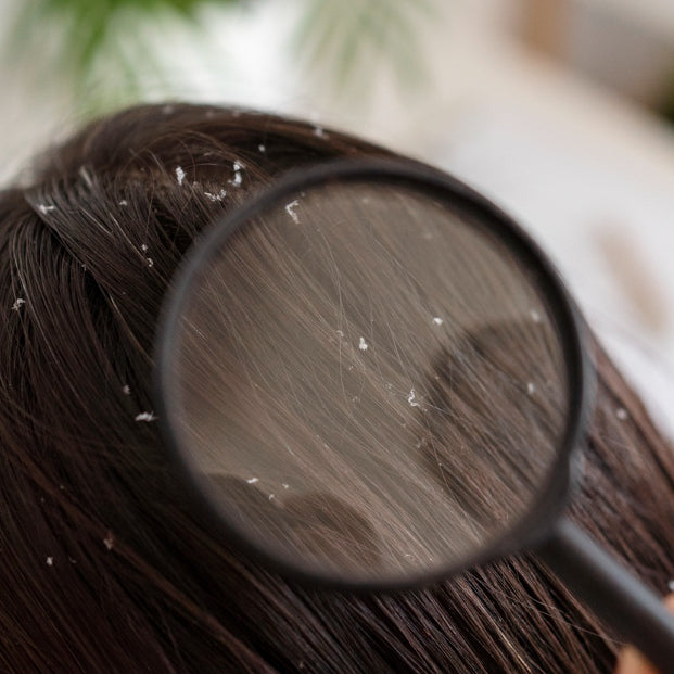 Mengatasi Ketombe dengan Metode Alami: Tips Sederhana untuk Rambut Sehat