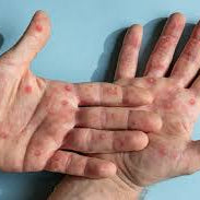 Waspada Cacar Monyet: Cara Penyebaran, Gejala, dan Pengobatannya