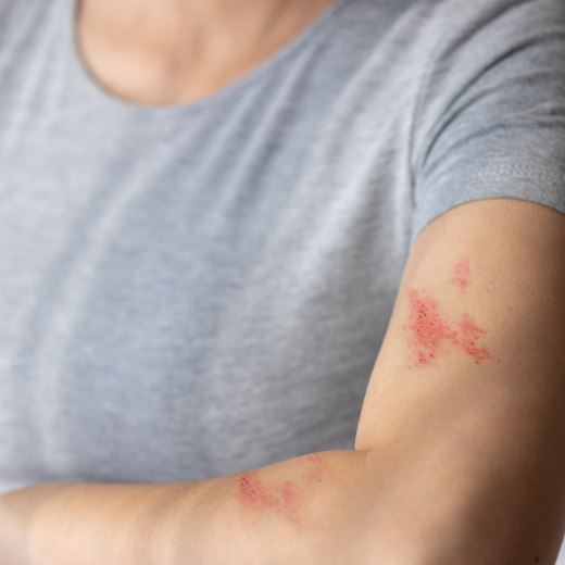 Mengungkap Berbagai Penyebab Herpes yang Perlu Diketahui