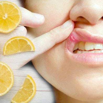 Mengatasi Sariawan: Penyebab, Gejala, dan Cara Pengobatan Efektif