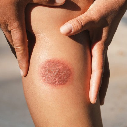 Pertolongan Pertama Saat Luka Bakar: Apa yang Harus dan Jangan Dilakukan