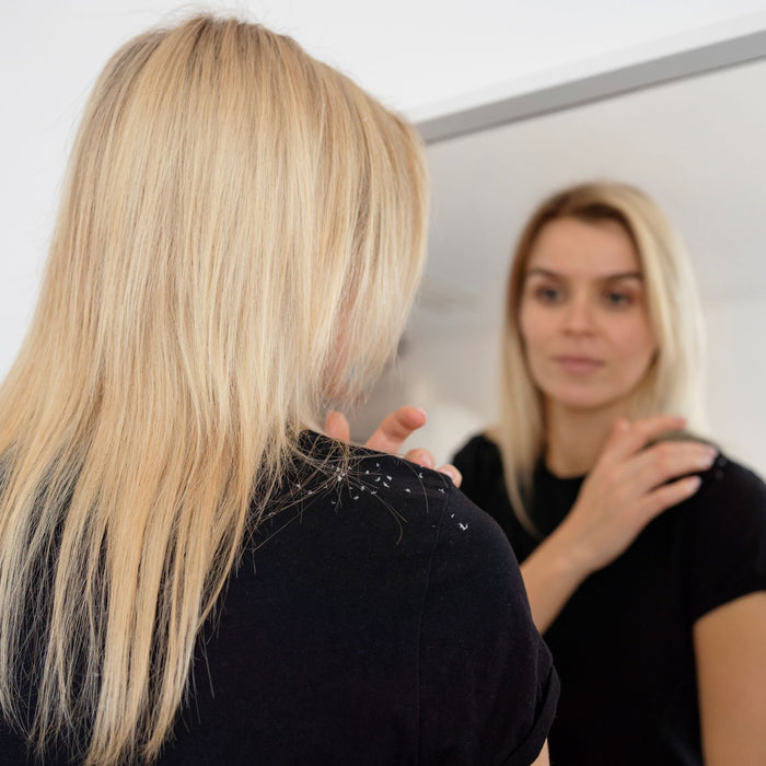 Cara Mencegah dan Mengatasi Ketombe: Tips untuk Kulit Kepala Sehat