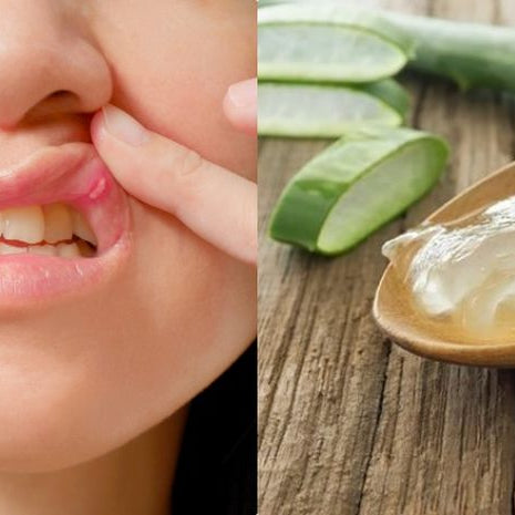 Sariawan Tak Lagi Mengganggu: Cara Alami untuk Meredakannya