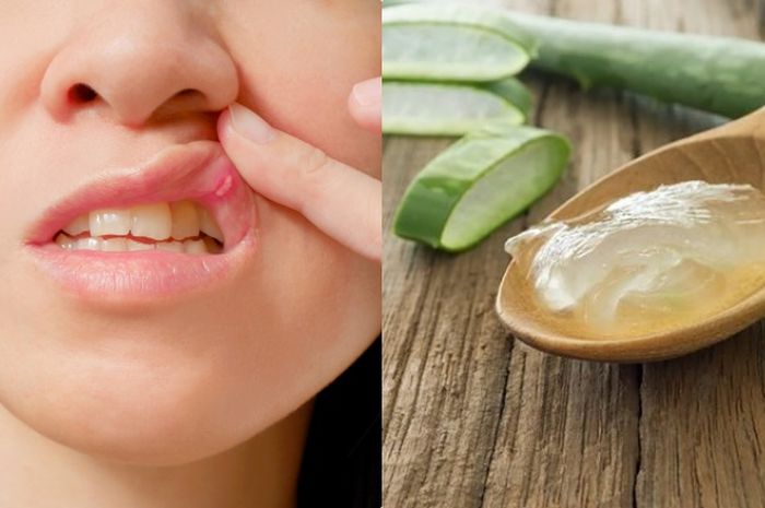 Sariawan Tak Lagi Mengganggu: Cara Alami untuk Meredakannya