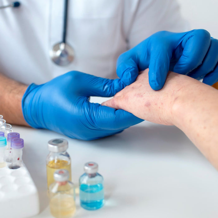 Cacar Air : Penyebab, Gejala, Pengobatan, dan Pencegahan