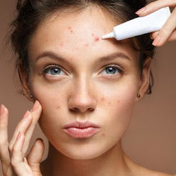 Panduan Merawat Kulit Wajah Berjerawat: Langkah-Langkah Efektif untuk Kulit Sehat